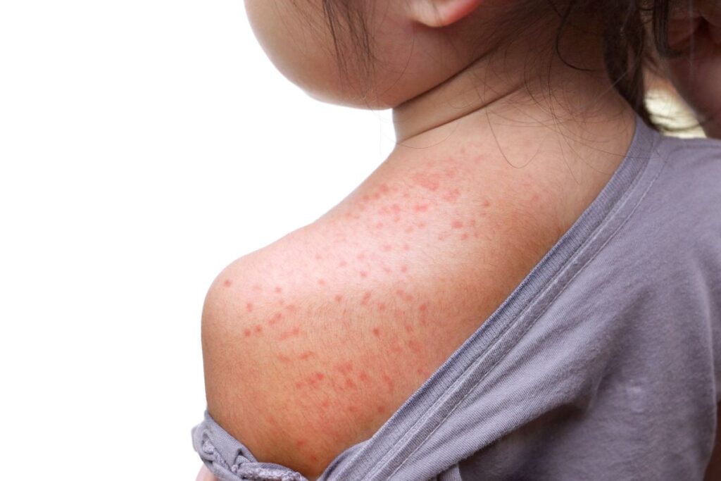 Situazione in Italia: morbillo in aumento tra i bambini. Casi anche tra gli adulti
