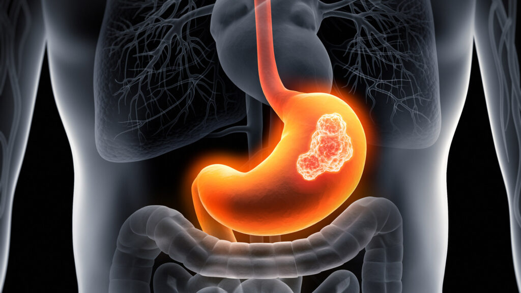 Tumore gastrico: nuove speranze in una battaglia difficile