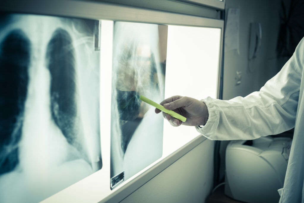 La speranza per le cure del tumore al polmone arriva dalla Commissione Europea
