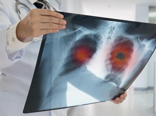 Salute respiratoria e stili di vita: la battaglia contro il tumore al polmone a tutti i livelli